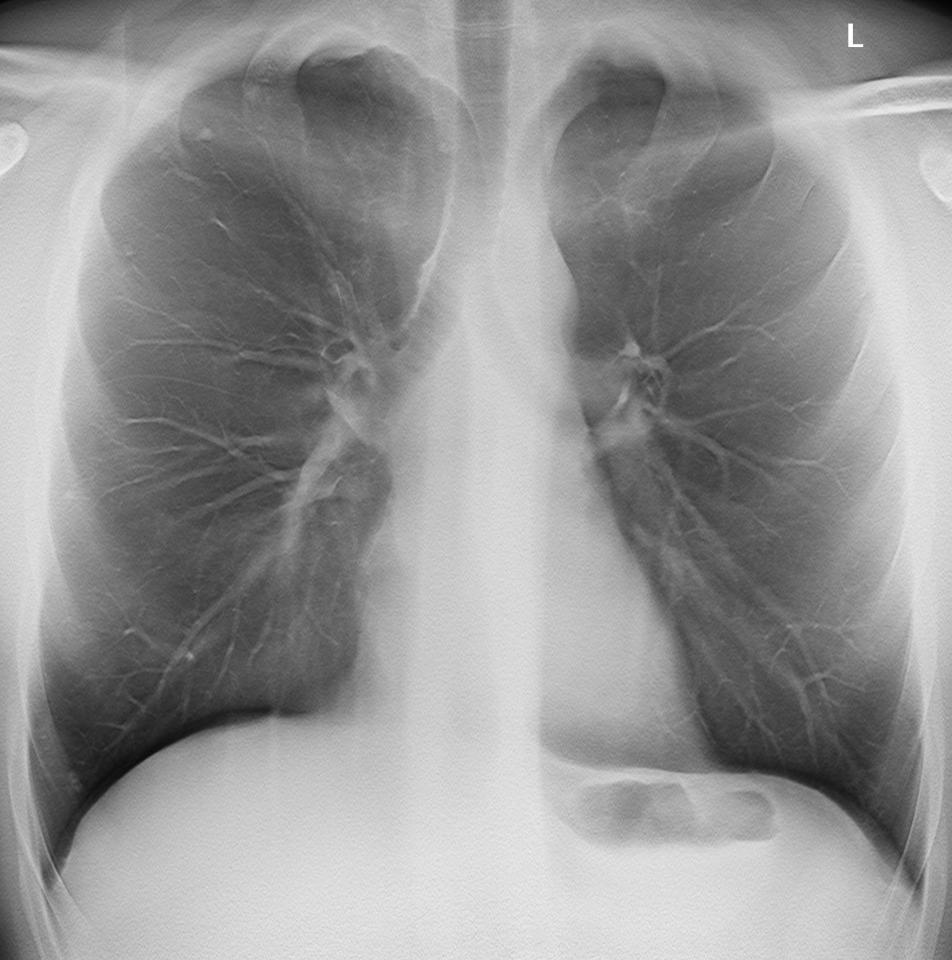 Lungtomosyntes + Förbättrad sensitivitet* + Förbättrad specificitet + Låg dos