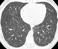 hypersensitiv pneumoni