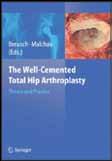 Revision total hip arthroplasty in patients younger than 55 years old. Clinical and radiological results after 4 years. J Arthroplasty 1988;3(1):47 59. Ahnfelt L, Herberts P, Andersson G B J.