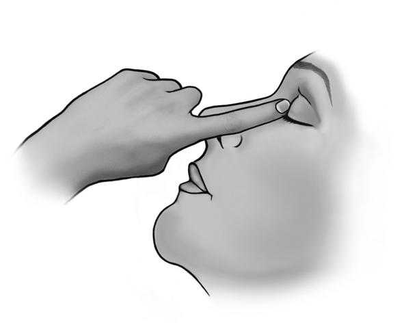 Om din läkare ordinerat dig att använda droppar i båda ögonen, upprepa steg 7 till 12 för det andra ögat. Innehållet i en endosbehållare räcker till båda ögonen.