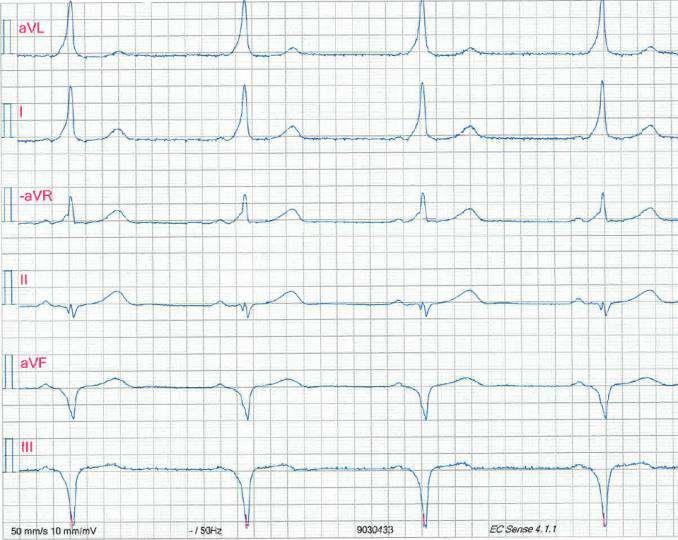 Fråga 1: Tolkning av vilo-ekg från