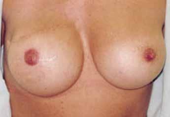 Dermapigmentation. Medicinsk bröstcancer pigmentering Masterutbildning Gör skillnaden för din kund!