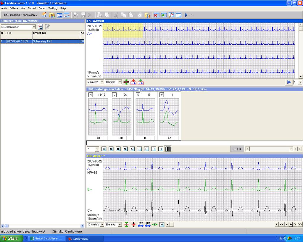 9.4 Analysfönstren EKG Efter det att du har dubbel-klickat på önskad registrering i databasen, eller efter det att datafilen har överförts från
