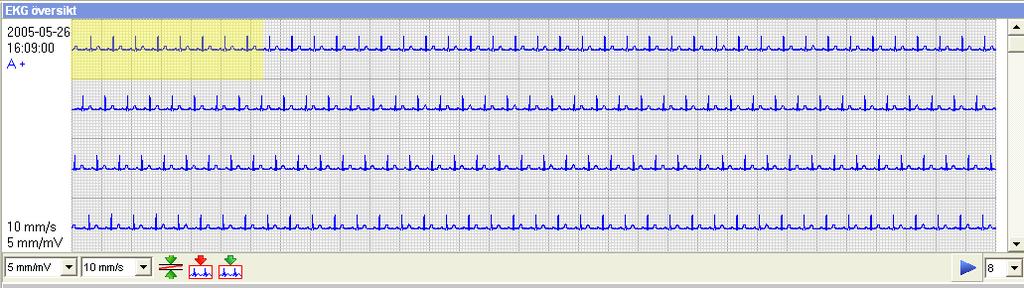 Om du klickar på en händelsemarkering så visas motsvarande EKG remsa i avsnittet (fönstret) EKG översikt.