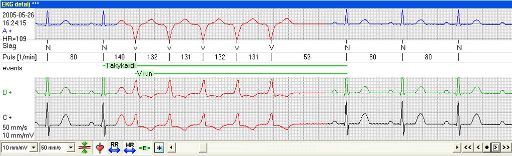 Bläddra i EKG översikten EKG översikten används huvudsakligen för att bläddra igenom registreringens hela EKG remsa. Bläddringen kan ske på olika sätt.