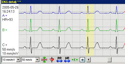 Markera slag (komplex) Du kan markera ett slag (QRS-komplex) i EKG detaljen genom att klicka på det med muspekaren, varvid det aktuella komplexet markeras med gult.
