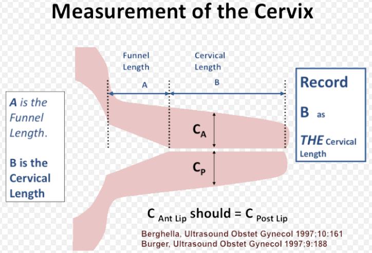 Mäta cervix med ultraljud Mer objektiv än palpation Teknik: Tom blåsa Cervix 75% av bilden Fram-och bakläpp