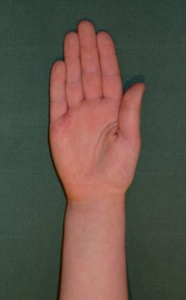 Tumme, Thumb-in-palm Tag passivt ut volarabduktion och notera om stramhet och/eller tecken på smärta kan observeras.