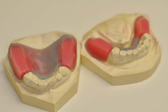 prepareras återstående tänder och en sista komplettering görs varefter punkterna 6-11 fullföljs. Betthöjd För registrering av betthöjd som skall förändras används indexet i första hand som referens.
