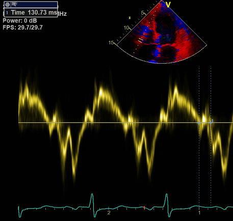 Samma patient 4 månader senare nu med VK svikt. HK-IVRT 131 ms; systoliskt HK-tryck 55 mmhg.