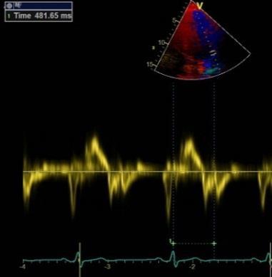 ICT, isovolumetrisk kontraktionstid, från mitralis stängning till aortas öppning. ET, ejektionstid, den tid när aortaklaffen är öppen.