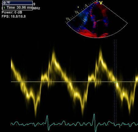 Högt tryck i höger förmak (d.v.s. ökat CVT) leder däremot till förkortad IVRT i höger kammare. Om CVT är normalt kan IVRT < 40 ms i det närmaste utesluta högt PA-tryck.