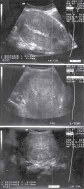 AJLANA MULIC-LUTVICA Figur 2 a, b, c Figur 3 a, b, c, d Ultraljusbild av uterus och kaviteten under puerperium: transabdominal i tidigt puerperium dag 1 (a) och i mittenperioden av puerperiet dag 7