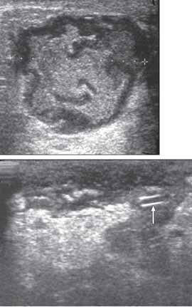 POSTPARTUM ULTRALJUD nadsekogenicitet, förtjockning av huden, ökad vaskularitet med färg-doppler eller dilaterade lymfkärl 28.