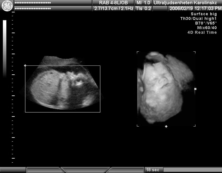 NYA DIAGNOSTISKA METODER 2-och 4-D bild av cervicalt teratom med tillåtelse av Peter Conner. FAKTARUTA 3D- och 4D-tekniken är i fortsatt utveckling och kan erbjuda fördelar i vissa fall.