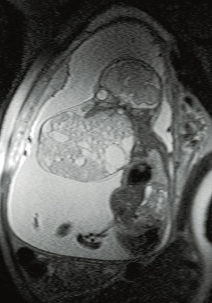 I dagsläget är den att betrakta som ett komplement till konventionell 2D-teknik vid misstanke om avvikelse i fosteranatomin. MR-bild av cervicalt teratom med tillåtelse av Peter Conner.