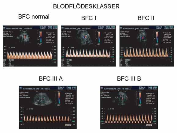 MEDICINSK ULTRALJUDSDIAGNOSTIK Figur 9 Blodflödesklasser av Dopplerspektra registrerade från a. umbilicalis.