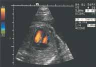 PER ÅKE OLOFSSON OCH KAREL MARSÁL Figur 10 Figur 11 Transducer Gråskale - linje 1 Färglinje 30 Färglinje 60 Gråskale - linje 90 Powerdoppler bild av fetal lungcirkulation (33 graviditetsveckor).