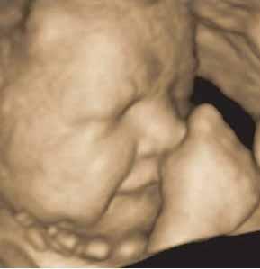 MEDICINSK ULTRALJUDSDIAGNOSTIK 3- och 4- dimensionellt ultraljud Genom att insamla ett stort antal 2-dimensionella bildsnitt och med hänsyn tagen till den position som insamlingen skett vid kan dessa