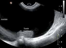ERGONOMI, UNDERSÖKNINGSTEKNIK OCH ARTEFAKTER Abdominell ultraljudsundersökning Abdominell ultraljudsundersökning används rutinmässigt för datering och missbilningsscreening kring vecka 18 (4), för