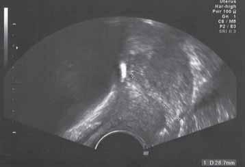 CERVIX UNDER GRAVIDITET nalt ultraljud är inför induktion av förlossning.