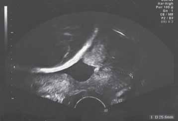 effektiv metod att förutsäga utfallet av induktionen (23). Figur 1a Cervix mäts mellan inre (imm) och yttre modermunnen (ymm).