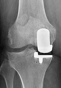 I enstaka fall ersätts även ledytan på knäskålen, men i allmänhet anses inte detta vara nödvändigt.