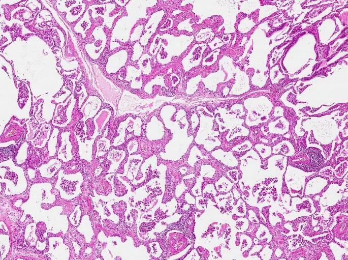 Ibland förekommer som bifynd alveolär/peribronkiolär bronkiolisering/metaplasi, osseös metaplasi, obliterativ endarterit och glattmuskelproliferation.