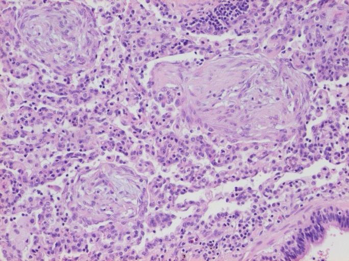 Mot slutet av fasen tillkommer makrofager, lätt kronisk inflammation och organiserande pneumoni.