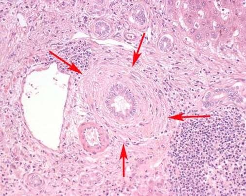 Primär skleroserande cholangit (PSC) - inflammation och fibros i de intra- och/eller extrahepatiska gallgångarna.