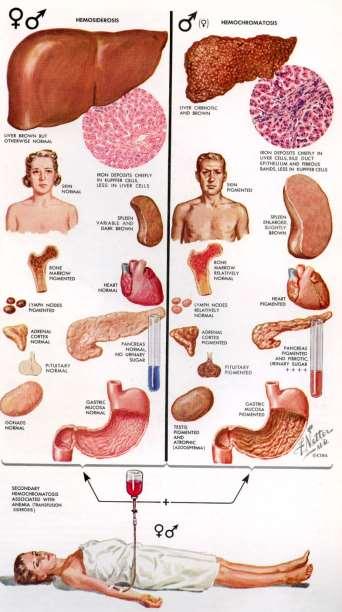 Hemokromatos ärftlig sjukdom med järninlagring i kroppen som obehandlad leder till cirrhos