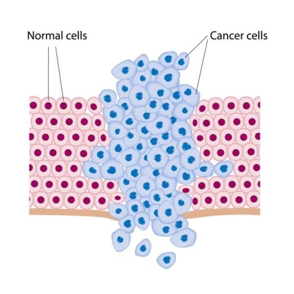 Cancer Cancer uppstår när vissa celler delar sig okontrollerat En tumör kallas då en klump av celler uppstår Cellen kan sprida sig till andra