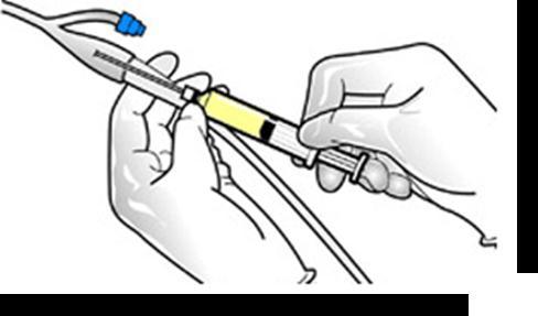 Rutin 8(10) Patienten ska vara informerad om varför katetern har satts, om den ska vara öppen eller proppad dagtid och hur länge katetern ska sitta, Patienten ska även informeras om var och hur ofta