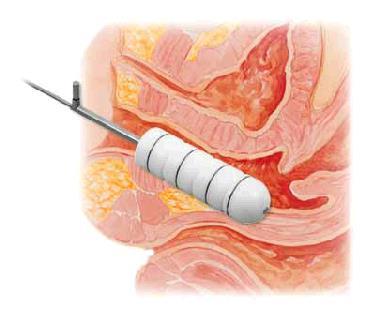Brachyterapi - vaginalcylinder Adjuvant (förebyggande) postop beh sterilisera mikrometastaser HDR 3Gyx6