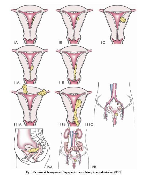 Stadieindelning och spridningsvägar 80% av fallen är begränsade till uterus vid diagnos IA IB Sprids per continuitatem genom muskelväggen, ut i parametrierna eller