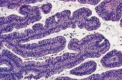 Patologi - histologisk typ (WHO) Endometroida adenocarcinom (vanligast, 80%) Mucinösa adenocarcinom 1-9% Serös adenocarcinom