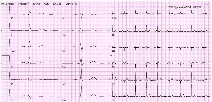 EKG Onormalt ökar sannolikheten för hjärtsvikt (låg specificitet) 1 Normalt är osannolikt vid hjärtsvikt (sensitivitet 89%) 2 Största användningsområde är att utesluta hjärtsvikt Q-våg över