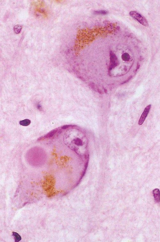 Förändringar i hjärnan vid Parkinson Utbredning av Lewy bodies Ansamling av äggviteämnen (proteiner) i klumpar inne i nervcellerna, fr a alfa-synuclein