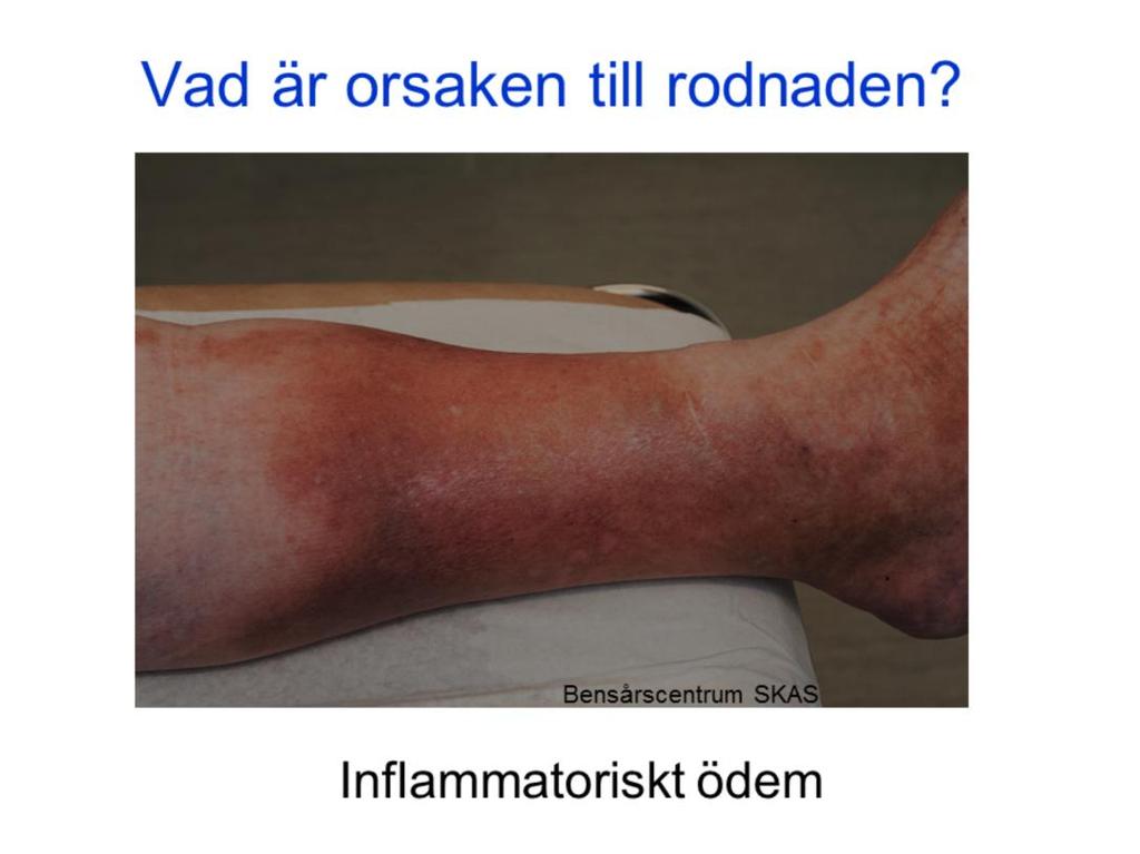 Här är orsaken till rodnaden ett inflammatoriskt ödem