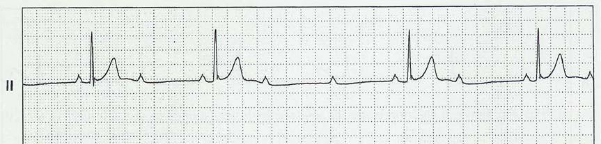 28 poäng totalt 1. Du har flera patienter som kommit till kliniken där du arbetar. Du tar EKG på dem.