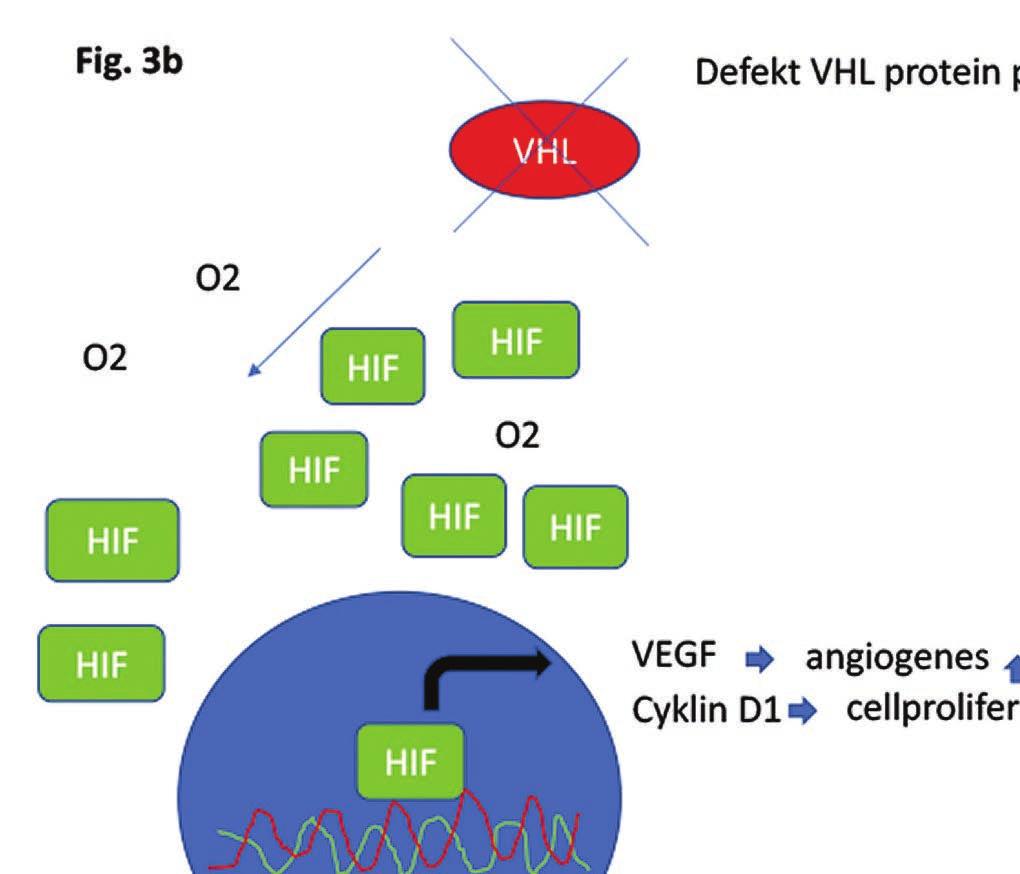 Vid normoxi binder VHL till HIF, vilket leder till nedbrytning av HIF (A).
