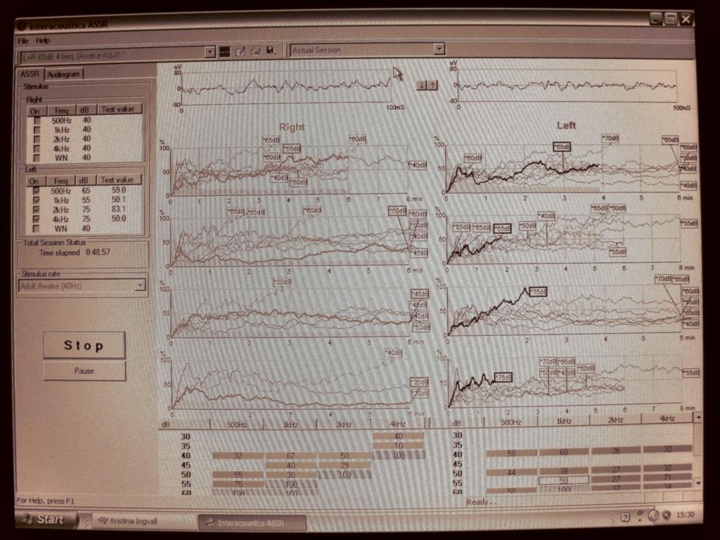 Instrument 1 Mätningarna utfördes på frekvenserna 0.5, 1, 2, och 4 khz och Mf 40 Hz användes (vuxen vaket tillstånd). Mätningen påbörjades vid 40 dbhl (rekommendation från firman) på varje frekvens.