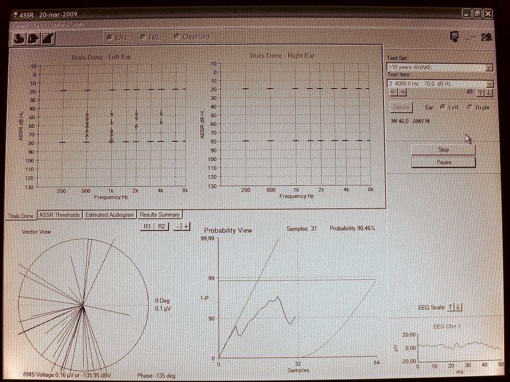 Instrument 2 Mätningarna utfördes på frekvenserna 0.5, 1, 2 och 4 khz för vänster öra med en Mf på 46 Hz (vuxen vaket tillstånd).