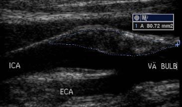 Emphysema Dyslipidemia