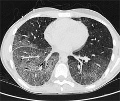 Liver steatosis (CT)