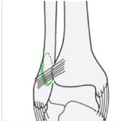 A3.3 Tvär lateral malleolfraktur nedom ledspringenivå och