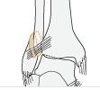 medial skada B2.