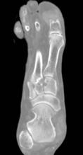 DUAL ENERGY CT (DECT) VID GIKT Ylva Aurell Figur 2 C. Coronart snitt, samma patient, visar erosioner på samma lokal med skelettfönster. Figur 3 A.