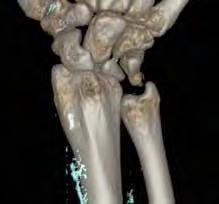 Transversellt snitt med rosafärgade uratkristaller i senorna kring handleden. Figur 3 C. Coronar datotortomografi-bild, samma patient, visar med skelettfönster en normal skelettstruktur.