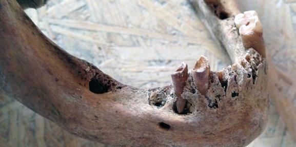 Ett rejält kariesangrepp syns även i övergången mellan krona och rot på tandens utsida. Detta kariesangrepp fortsätter bakåt längs med tanden och slutar på tandens insida (se fig 8 och 9).